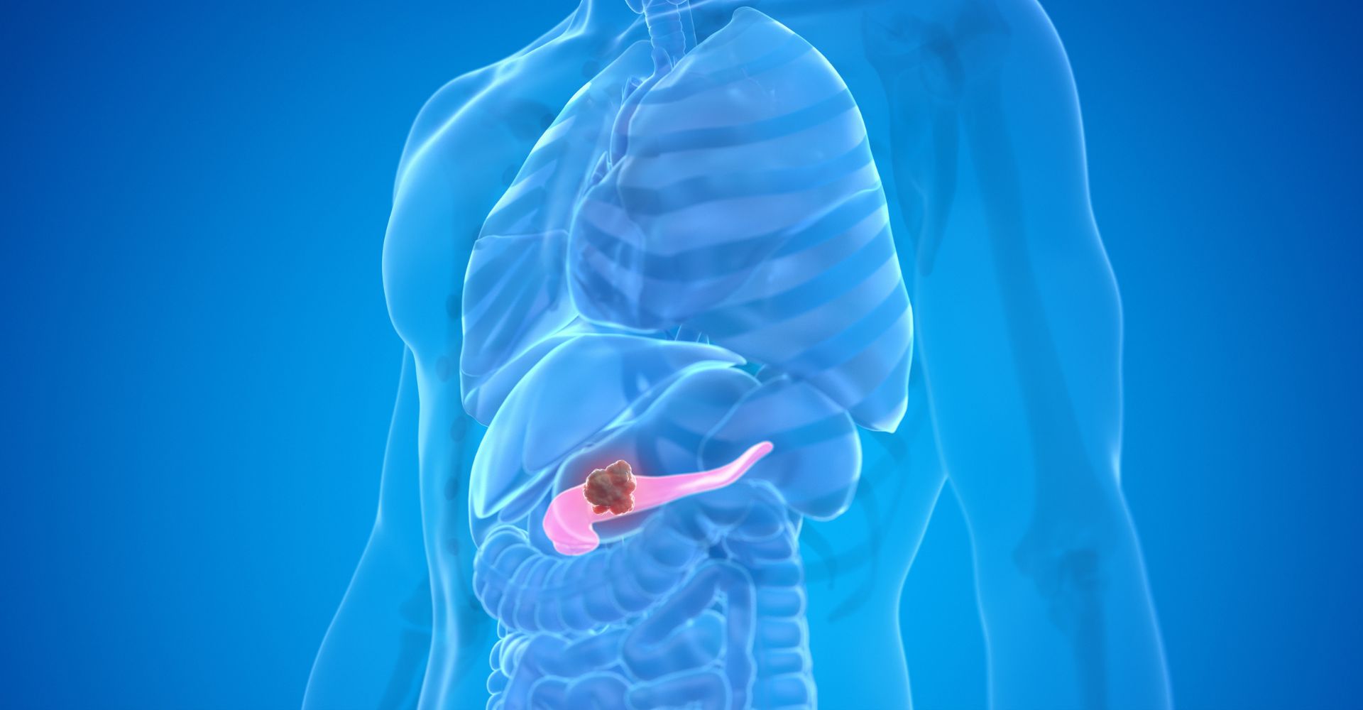 Pancreatic Cancer Treatment by Dr Vijay Bansal